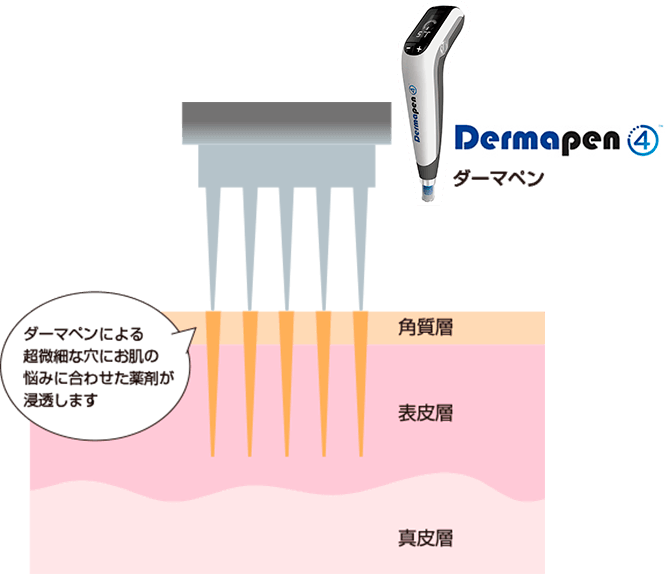 最新「ダーマペン４」 | シミ・シワ・たるみ専門クリニック、福岡 